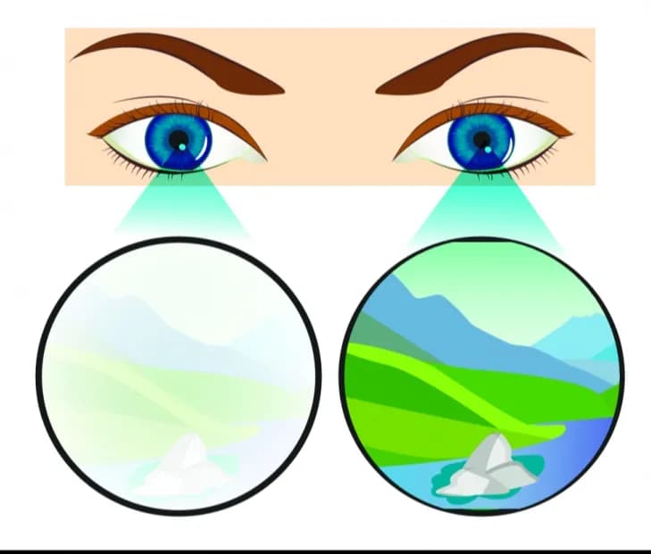 Entendamos el ojo perezoso (Ambliopía)