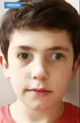 العلاج الرقمي للحَوَل المتقطّع