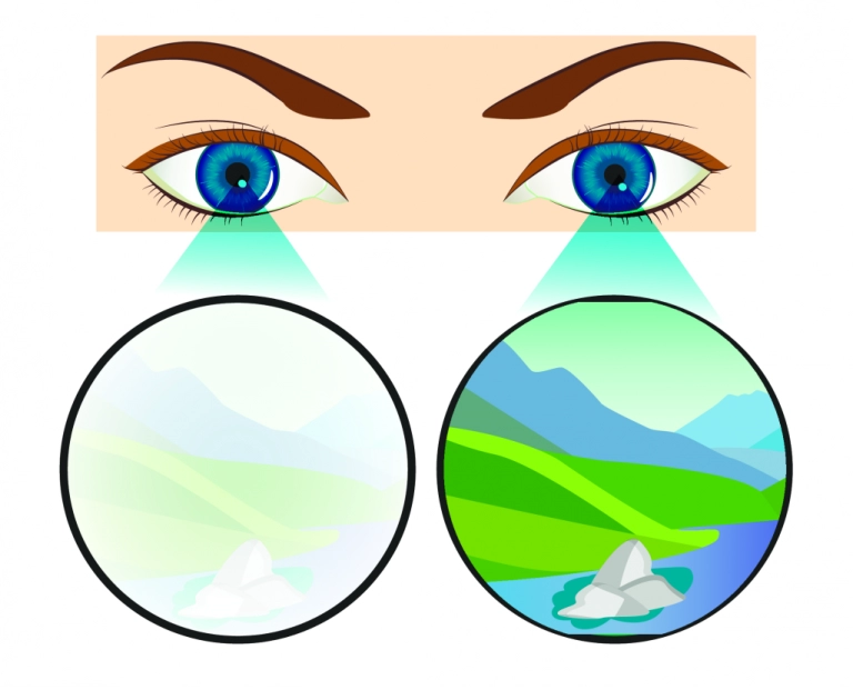 liječenje ambliopije lijenih očiju